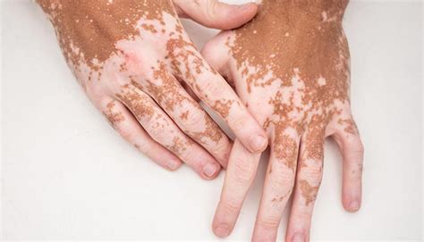  Vitiligo: 探索失色的世界，重現色彩的奇蹟！